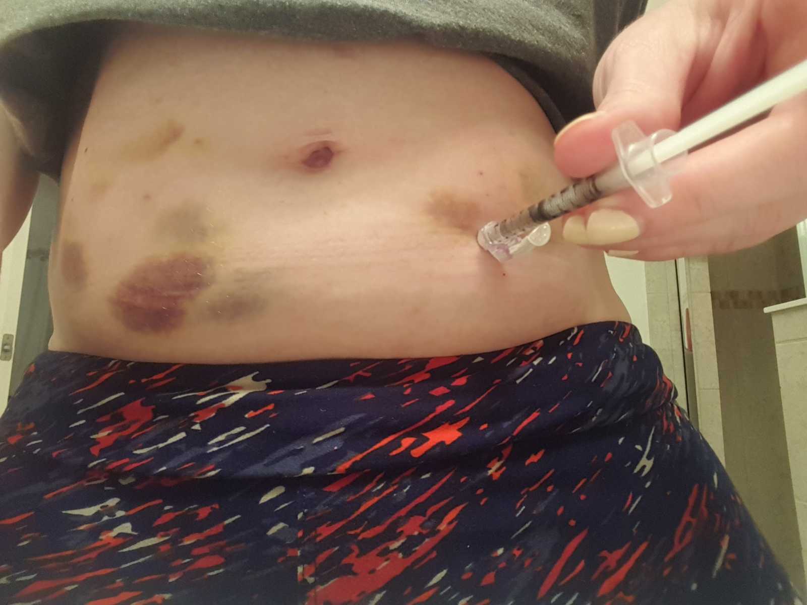 toddlers being injected with a needle on his stomach that is covered in bruises
