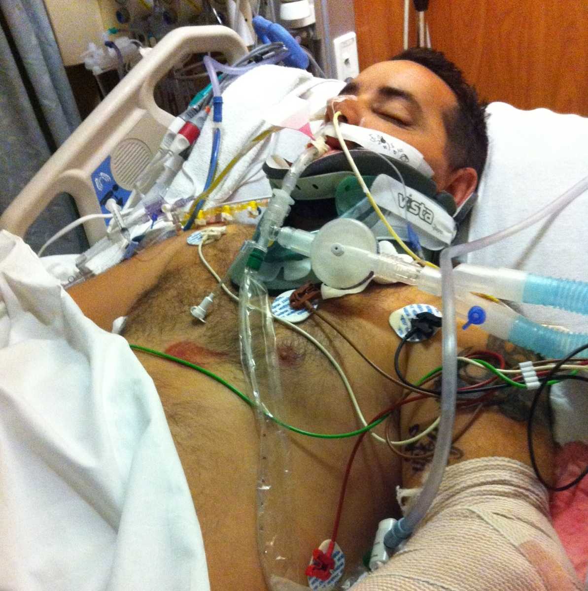 soldier lying in hospital bed with his short off and cast on his arm with machines hooked up to his chest and face
