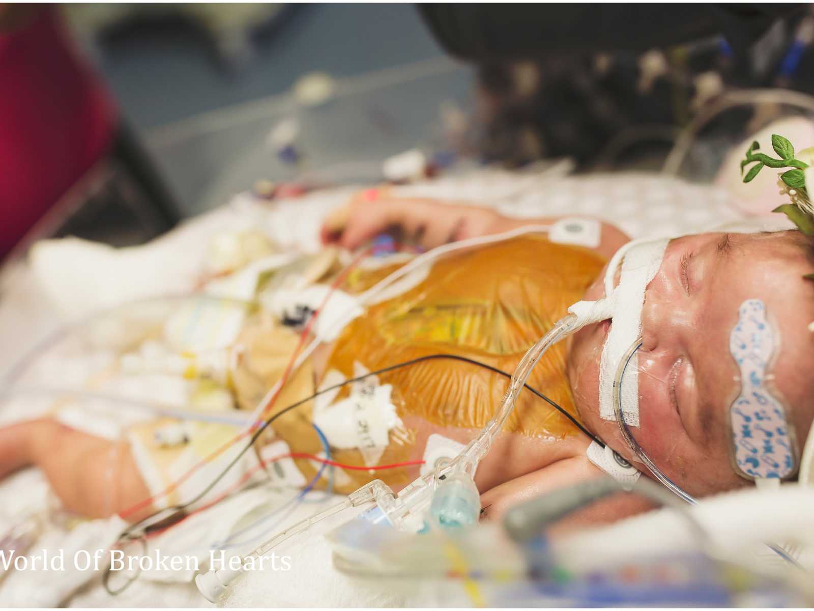 Close up of baby with heart defect sleeping with oxygen up her nose and wires attached all over her body