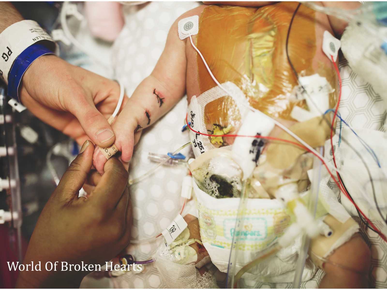 Close up of newborn baby with heart defect with stitches in her arm, wires attached to body, holding hands with parents