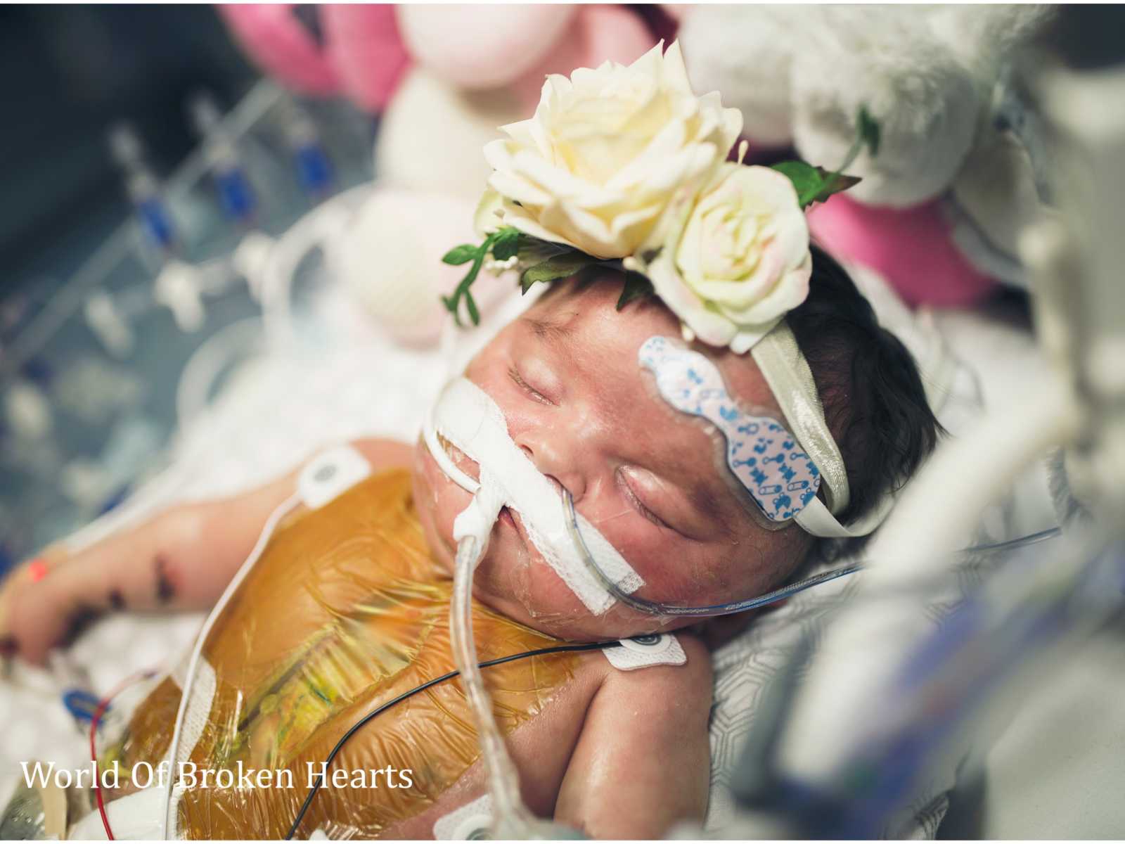 Twin with heart defect lies in hospital bed with flower headband and oxygen up her nose and wires attached to body