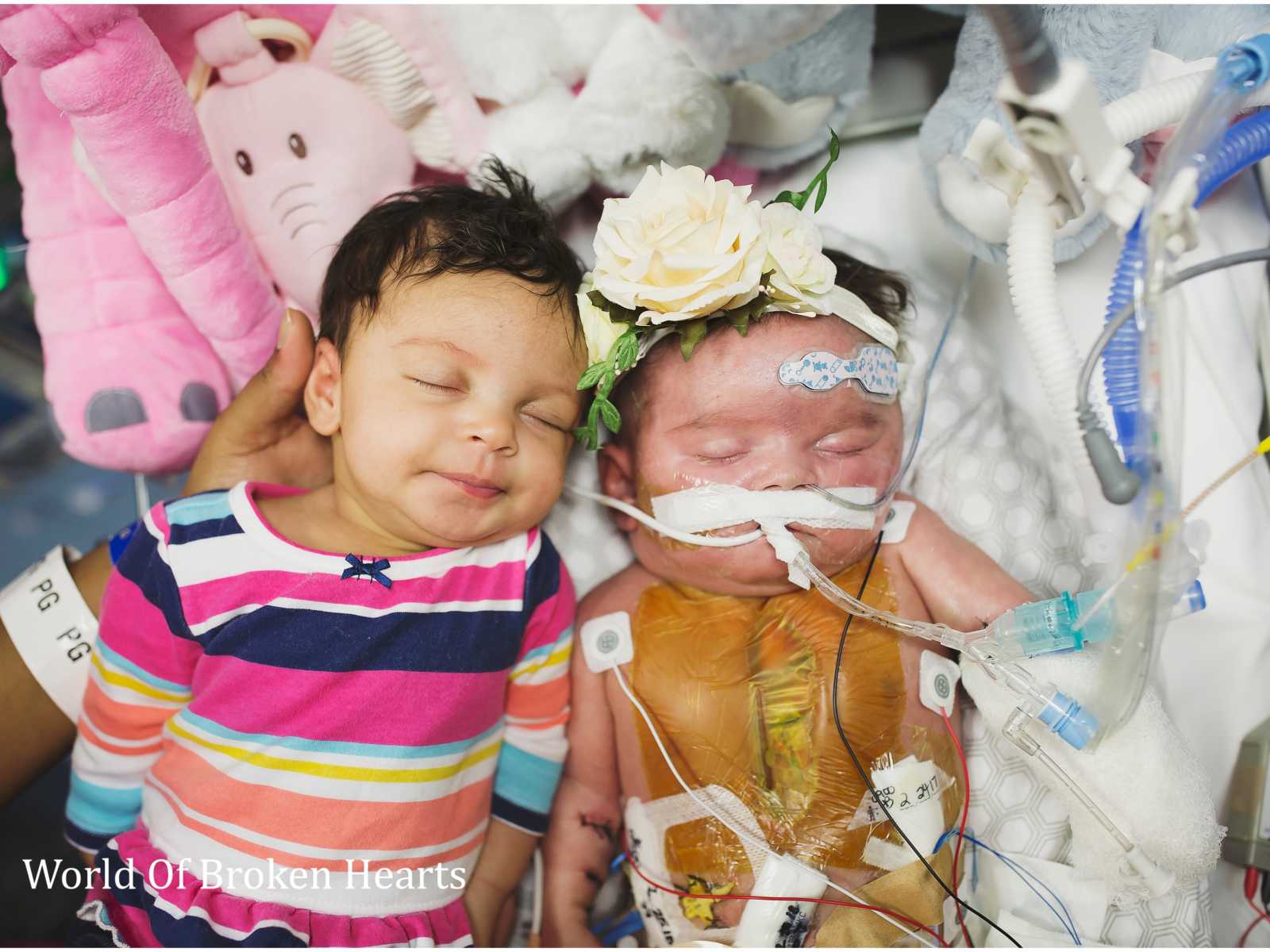 Twin sleeps next to twin with heart defect in hospital bed surrounded by stuffed animals