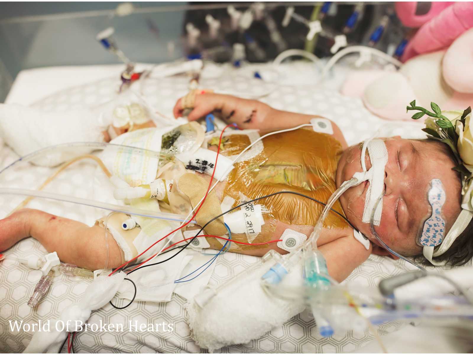 Close up of baby with heart defect lying in hospital with wires all over her body 