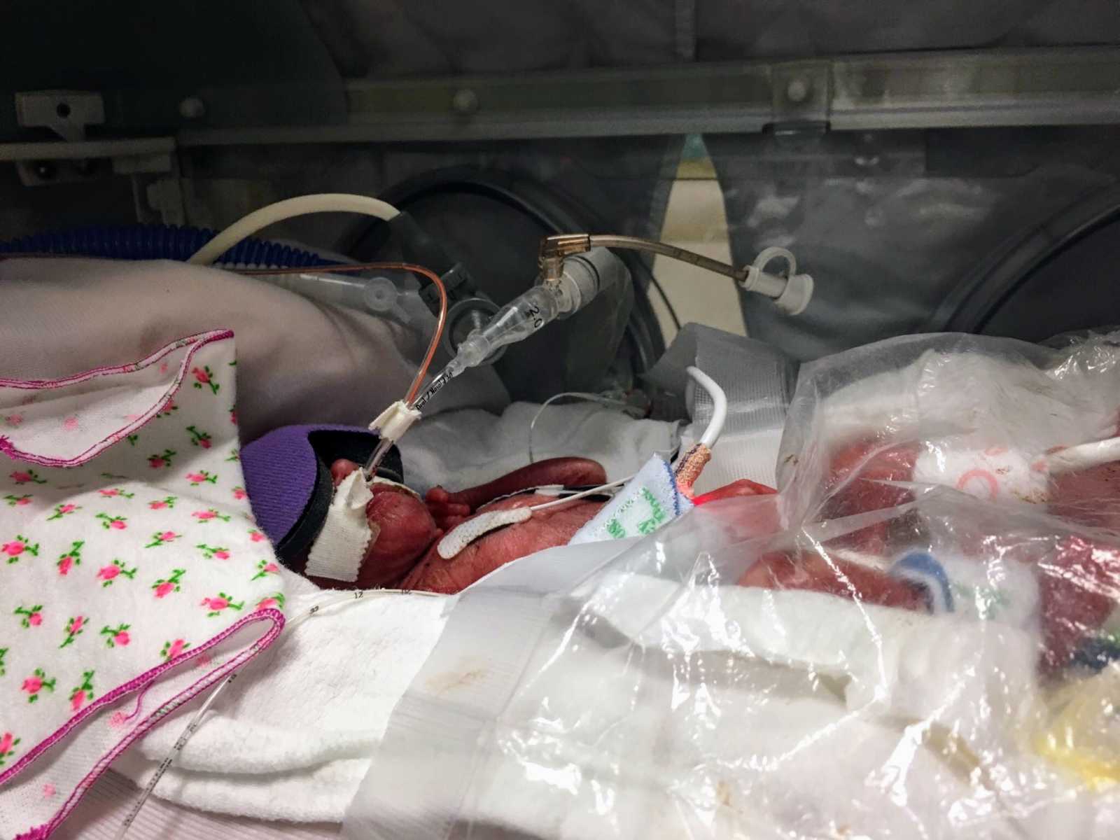 Preemie 1 pound baby lays in NICU with eye mask over her face and wires attached to her body