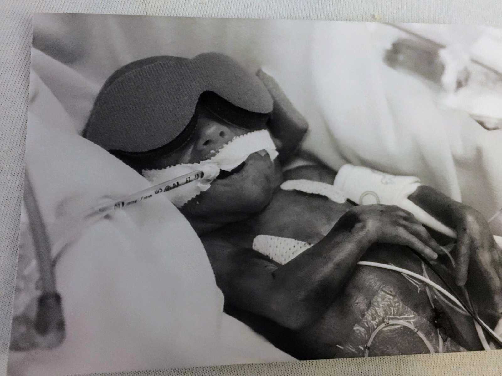 Preemie 1 pound baby lying in hospital bed with eye covers on and wires attached to her body