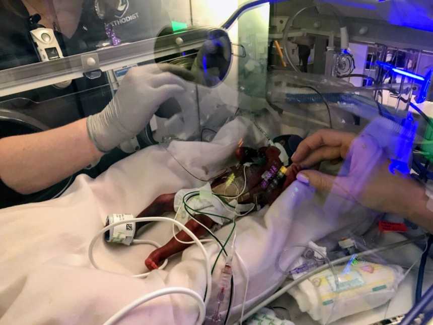 Nurses touch preemie 1 pound baby in NICU