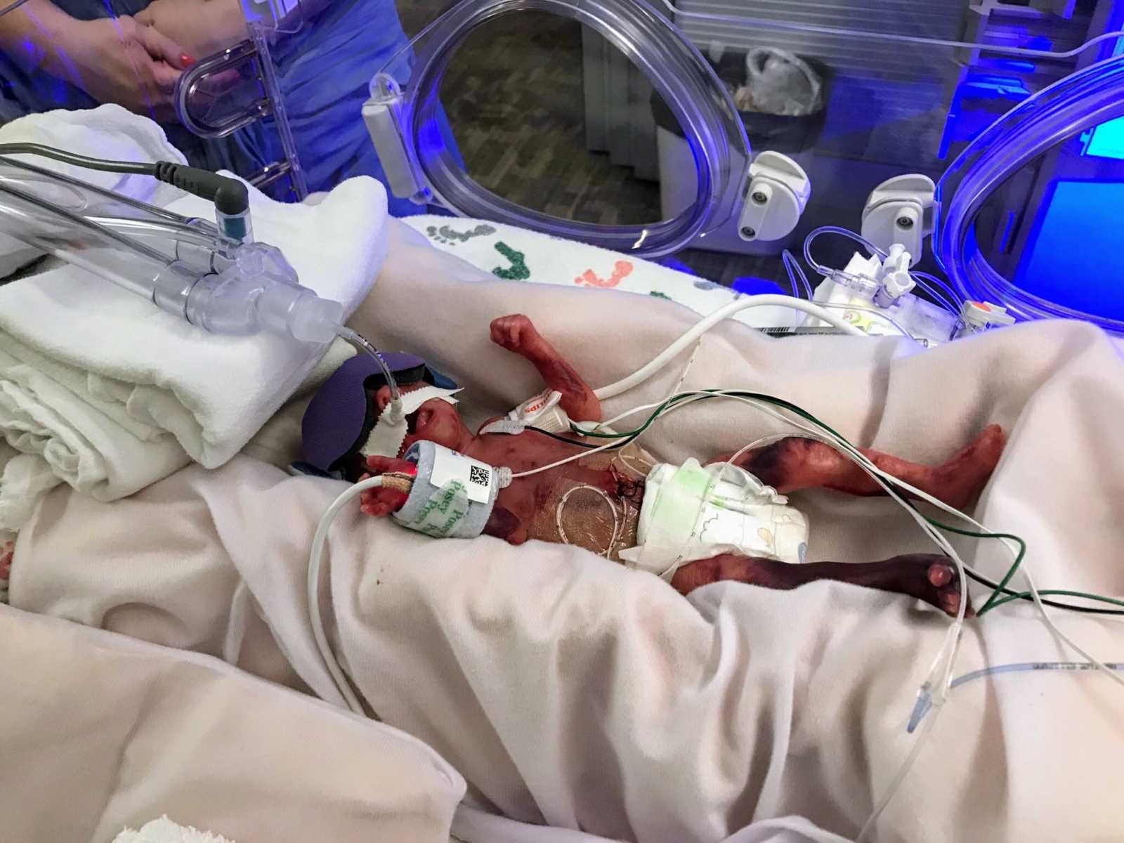 Preemie 1 pound baby in NICU with oxygen on mouth and wires attached to her body
