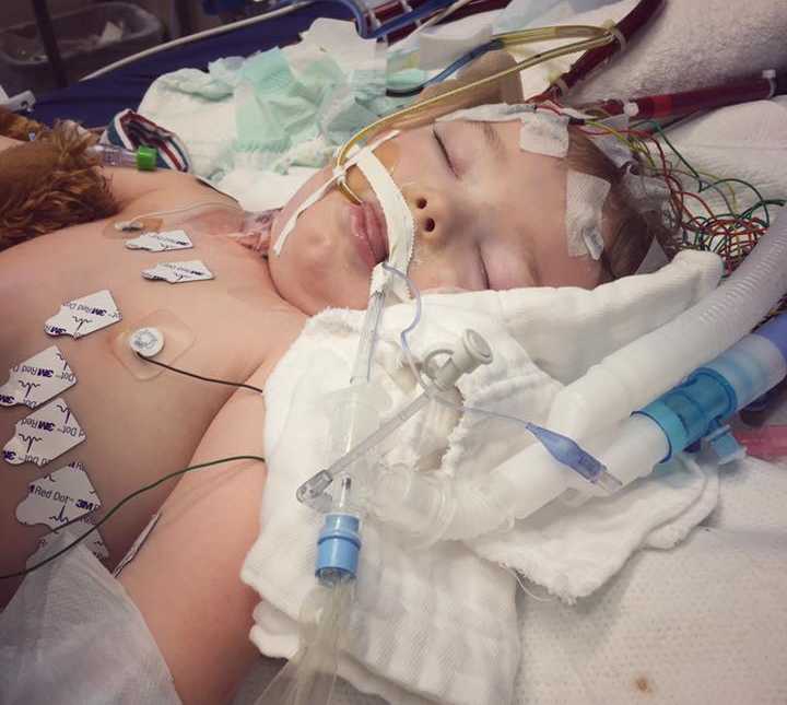 toddler boy shirtless and asleep in hospital bed with wires attached to chest and head