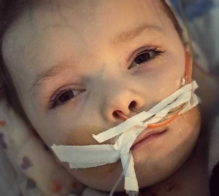 close up of sick toddler with eyes open with an orange and clear wire up his nose held by white tape
