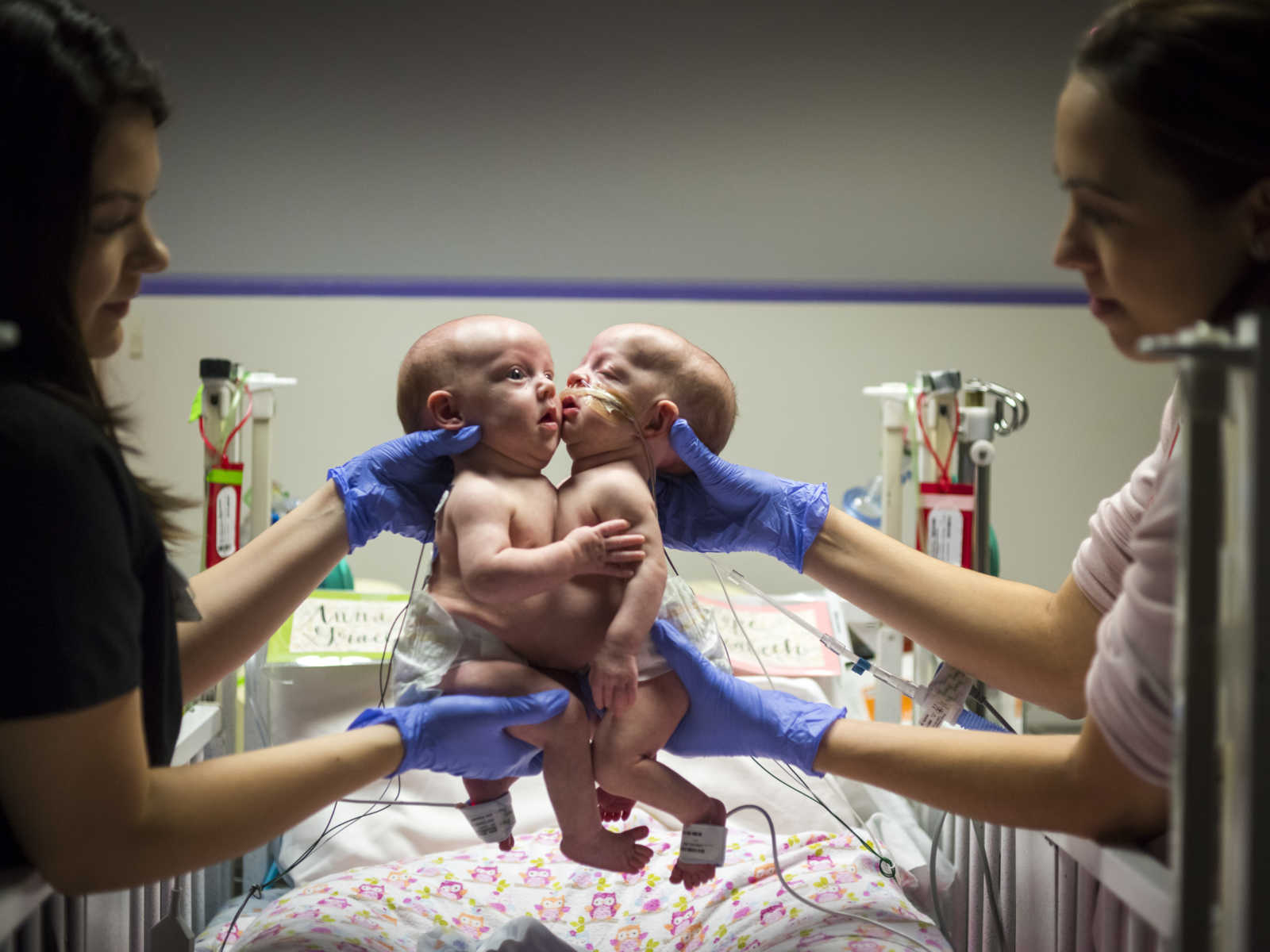 conjoined newborns being held in the air above hospital bed by two women on either side of them 