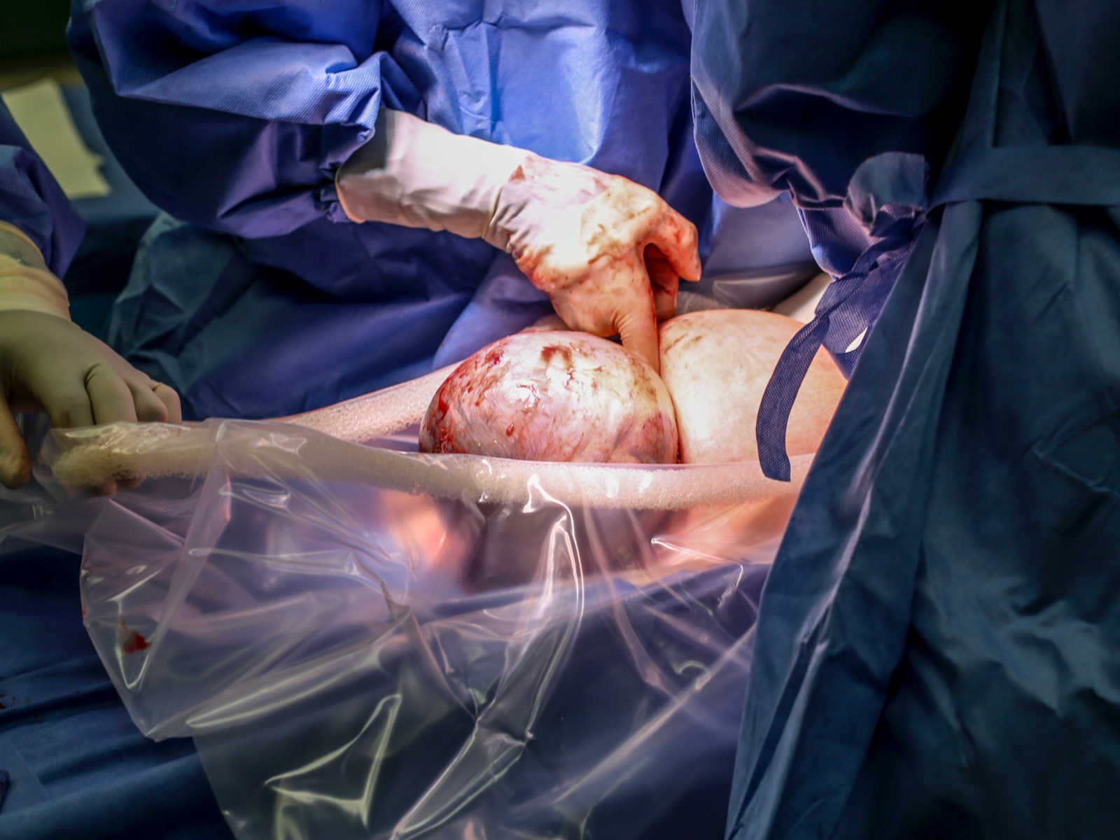 OBGYN touching newborn whose head is still covered in amniotic sac