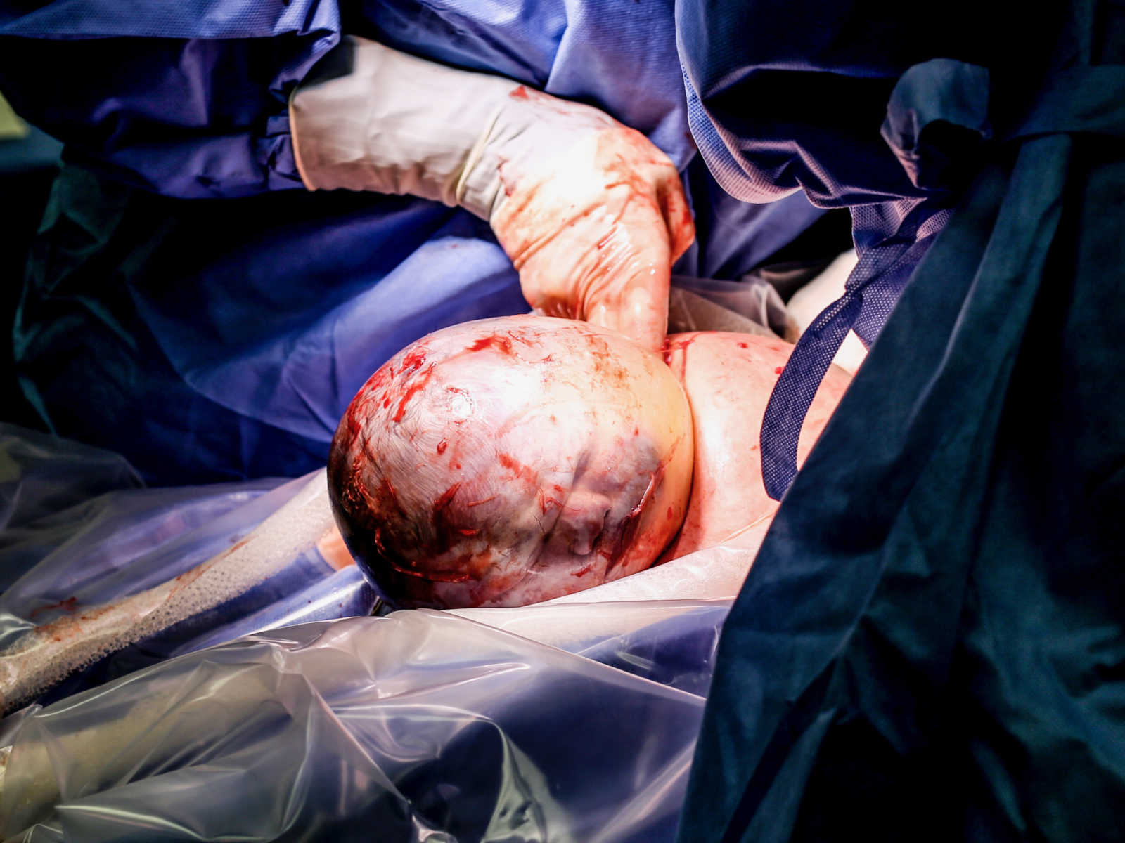 Close up of OBGYN touching newborn whose head is still in amniotic sac