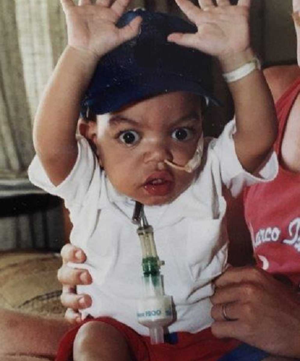 toddler with cerebral palsy sitting down with hands in the air and a tube coming out of his nose