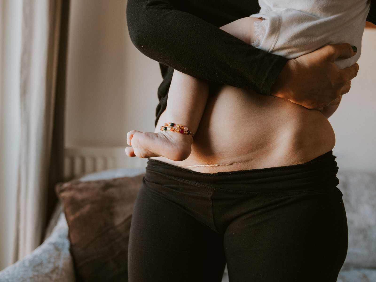 Close up of woman's c-section scar covered in gold dust while holding baby