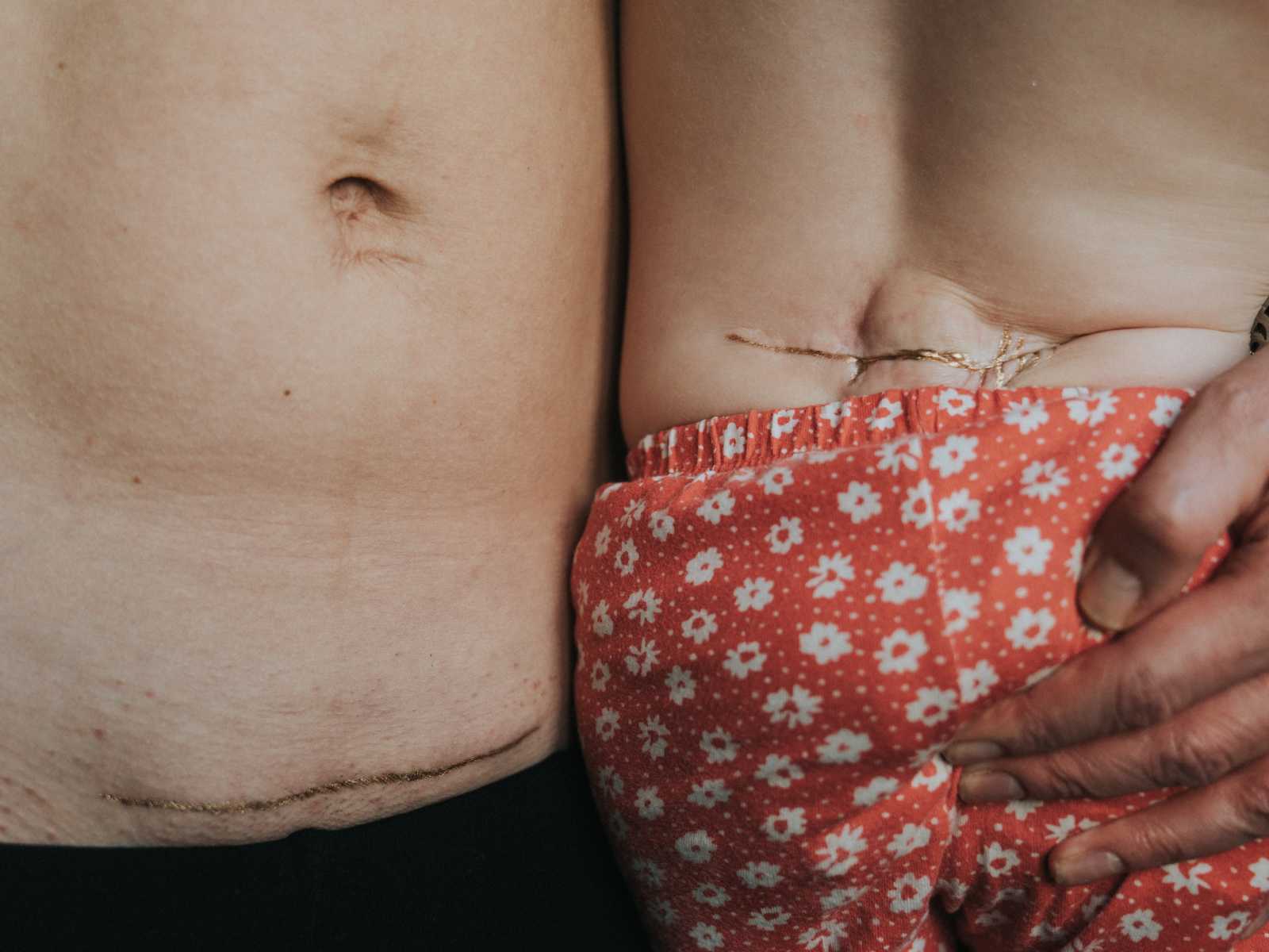 Close up of woman's c-section scar covered in gold dust holding baby baby with scar on back in gold dust