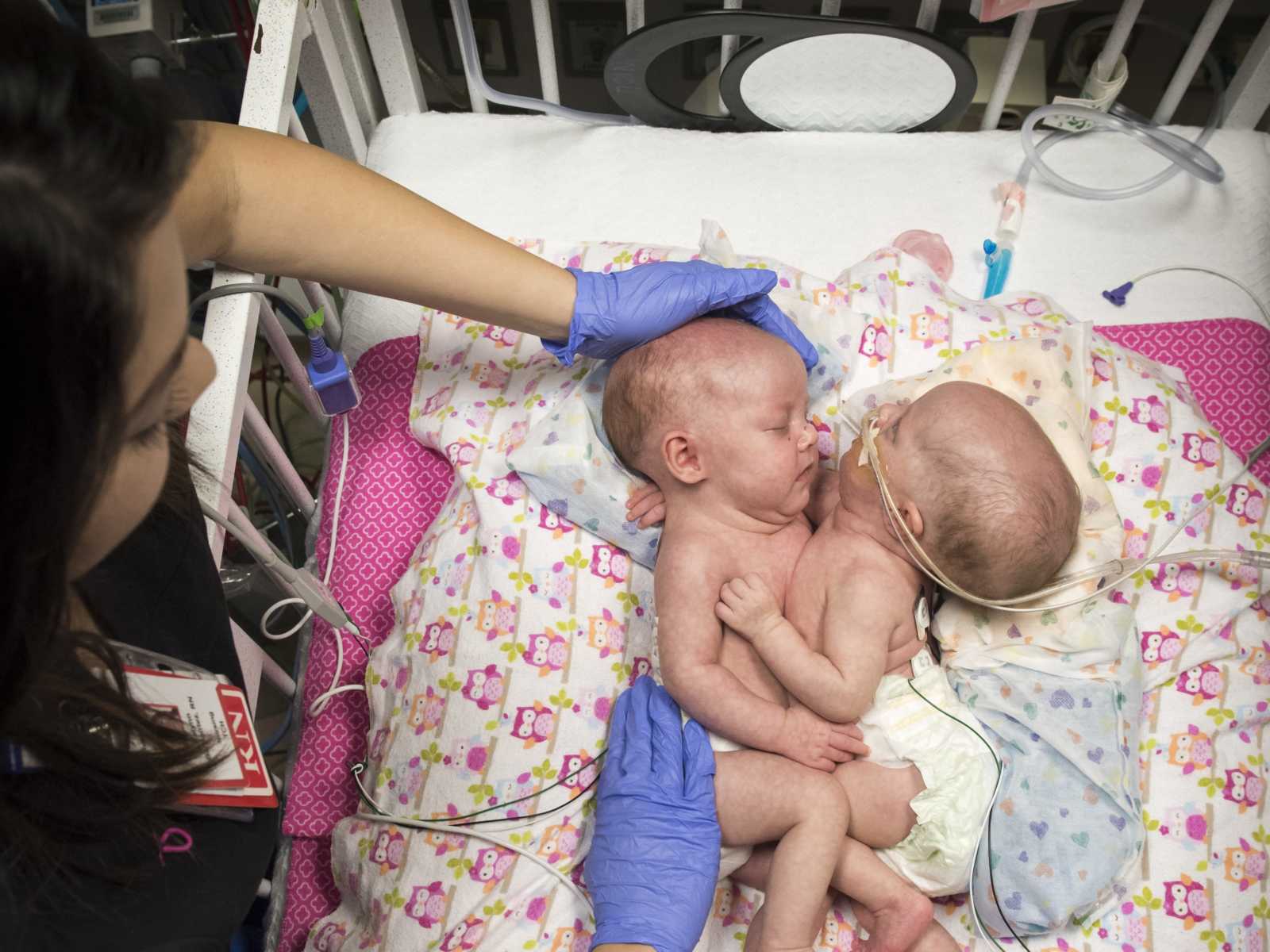 aerial view of conjoined twins lying in hospital bed with nurse placing hands on head and legs of one twin