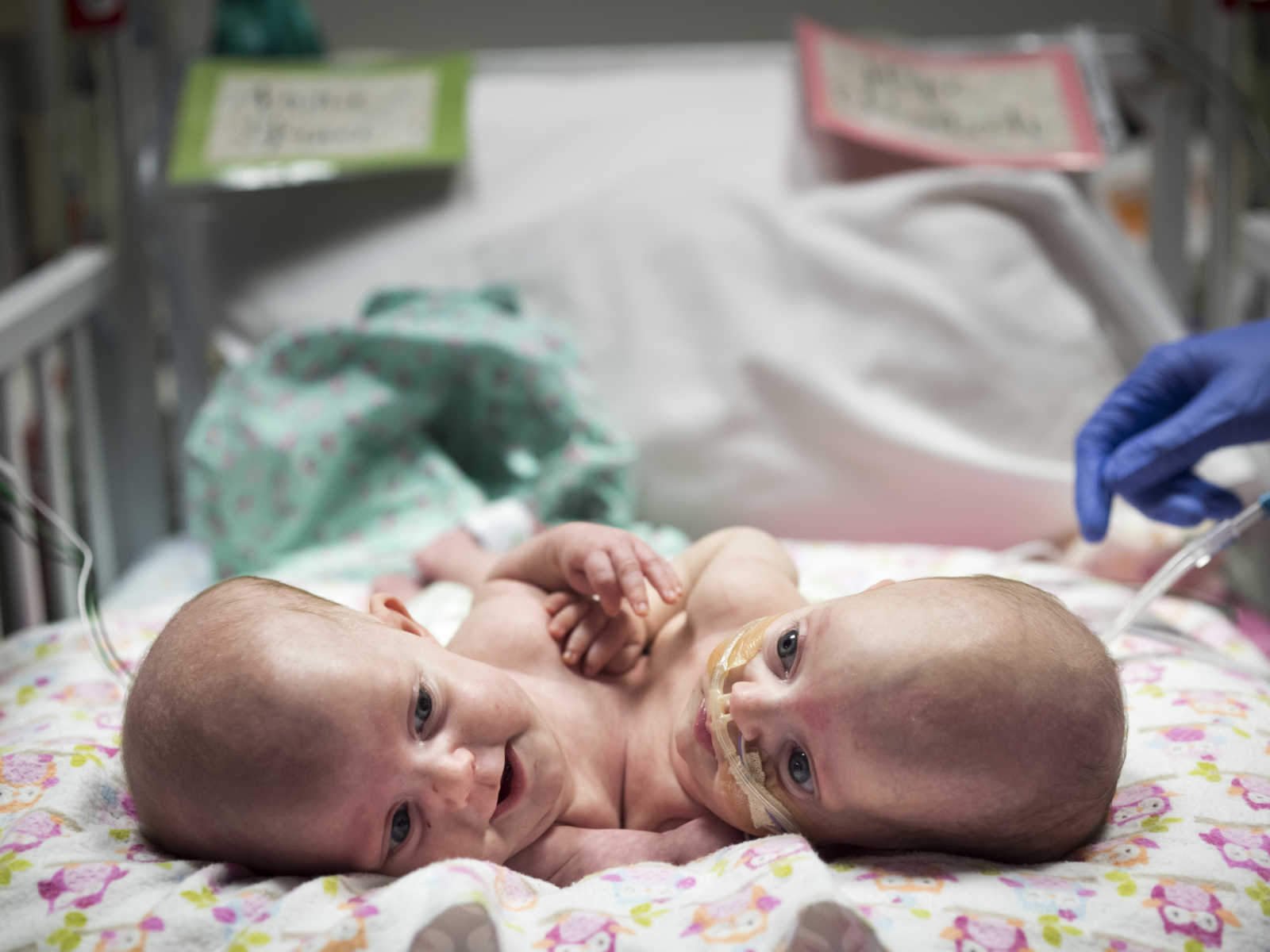 conjoined twins lying in hospital bed on baby blanket with owls with their names on the bed