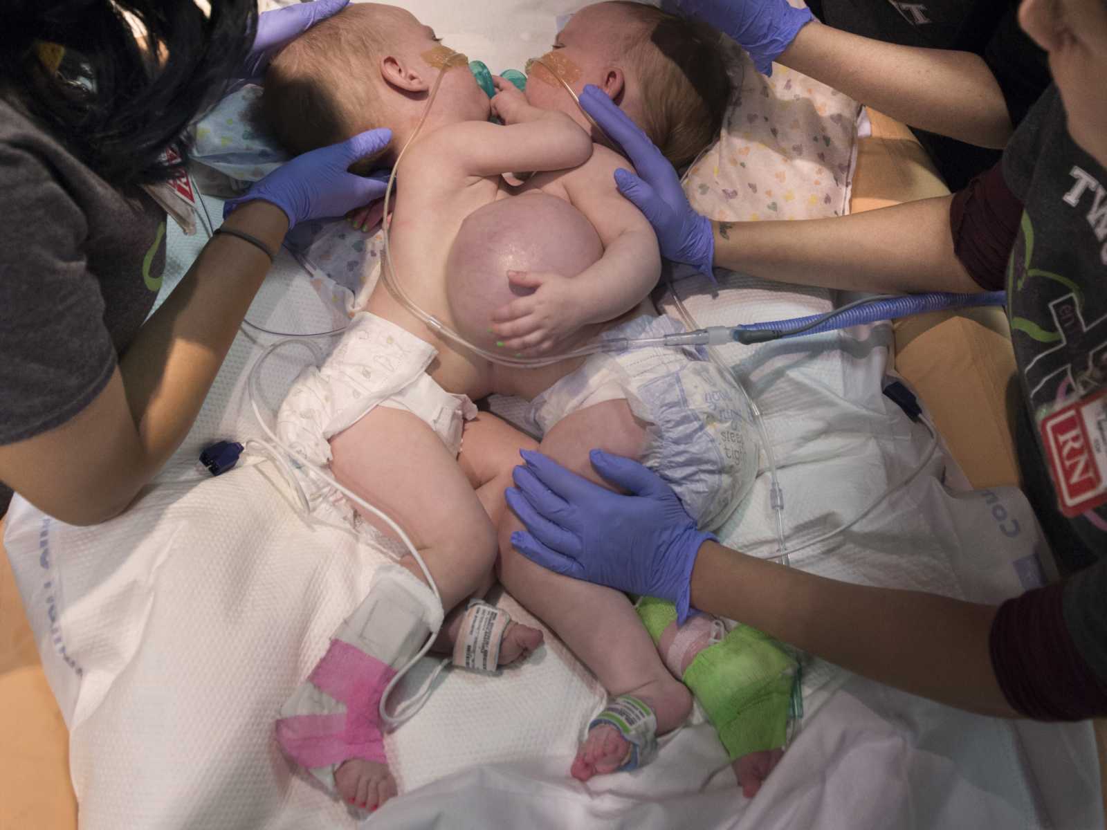 aerial view of conjoined twins in hospital bed with people touching them with blue latex gloves on