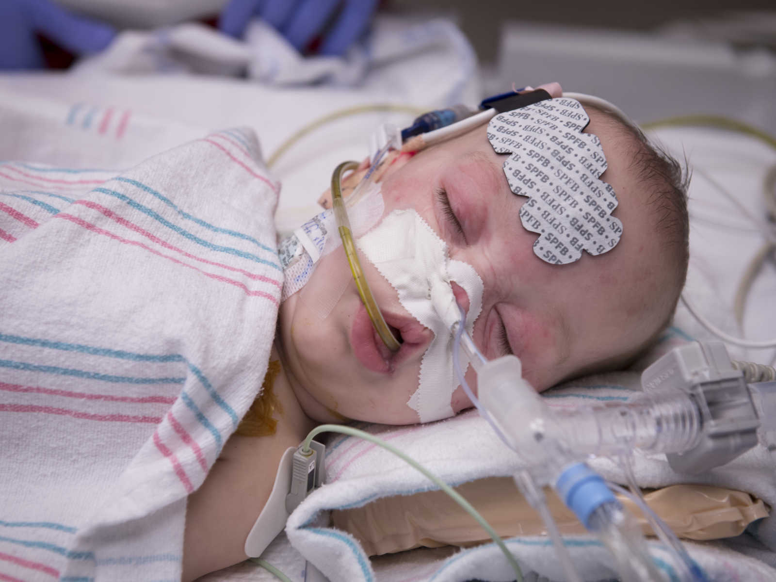 baby after surgery wrapped in pink and blue striped blanket sleeping with patch on forehead and wires in nose and mouth