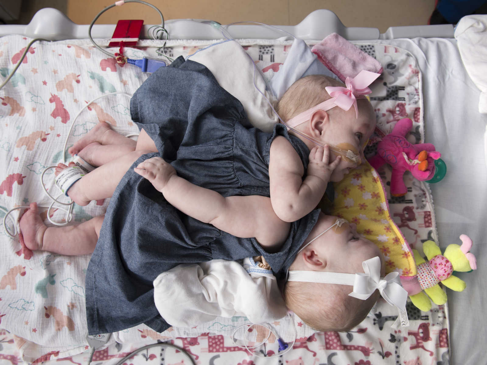 conjoined twin girls in gray dress and headbands lie on baby blanket with toys by their heads