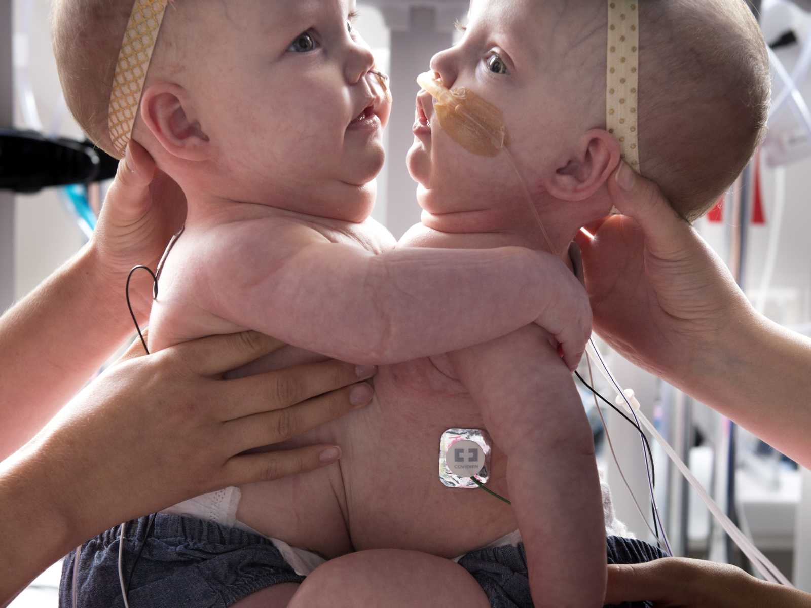 newborn conjoined twins attached at the chest being supported at the head by hands 