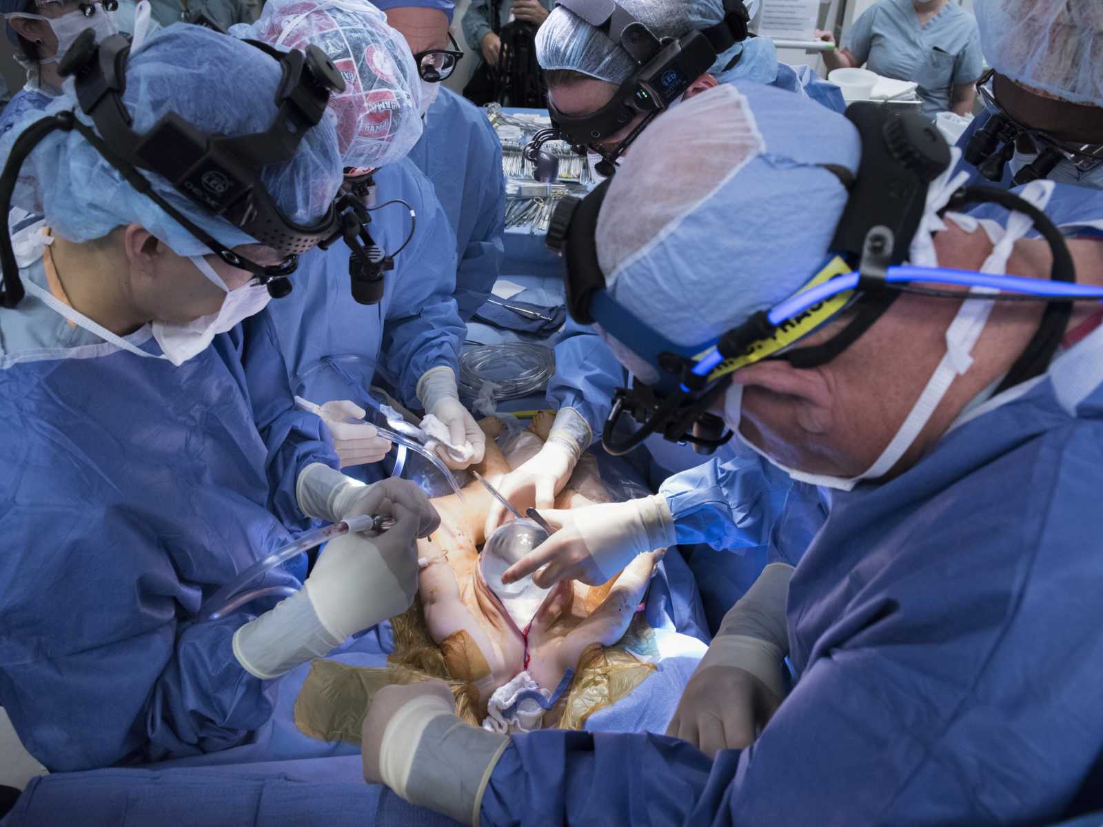 surgeons in blue scrubs and hairnets preform surgery on conjoined twins