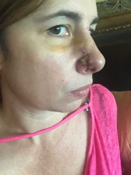 Woman with scar on her nose from skin cancer removal