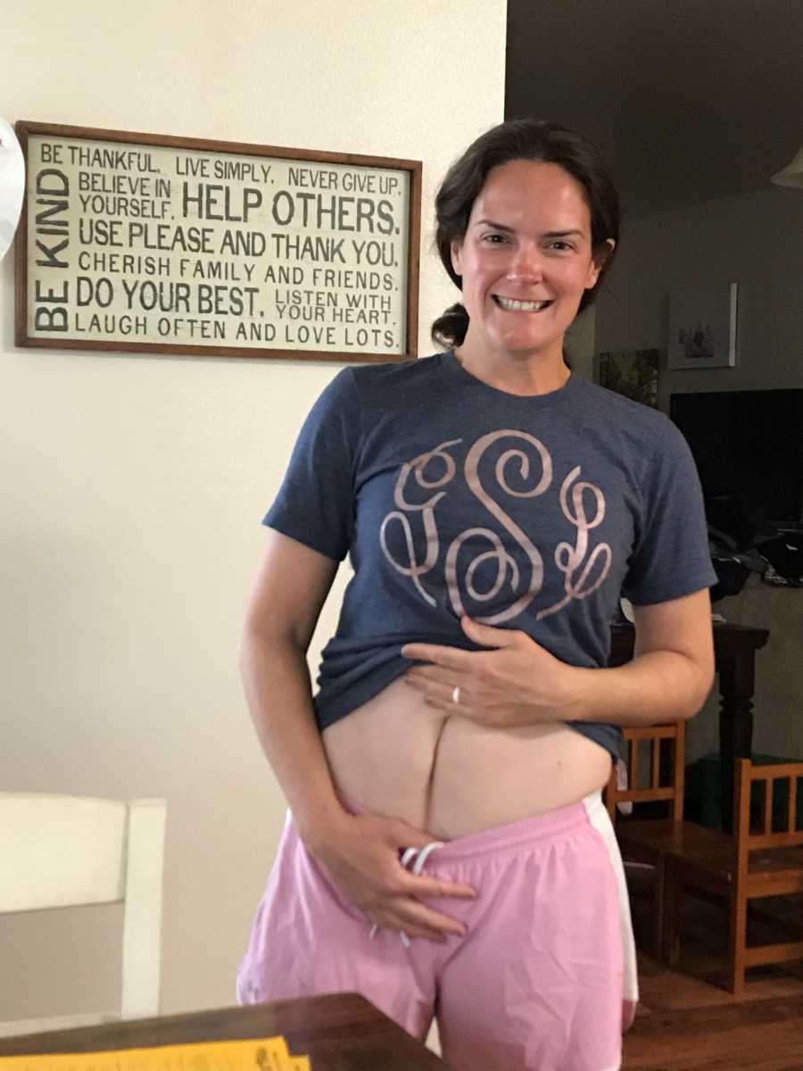Woman holding up shirt revealing ruptured appendix scar
