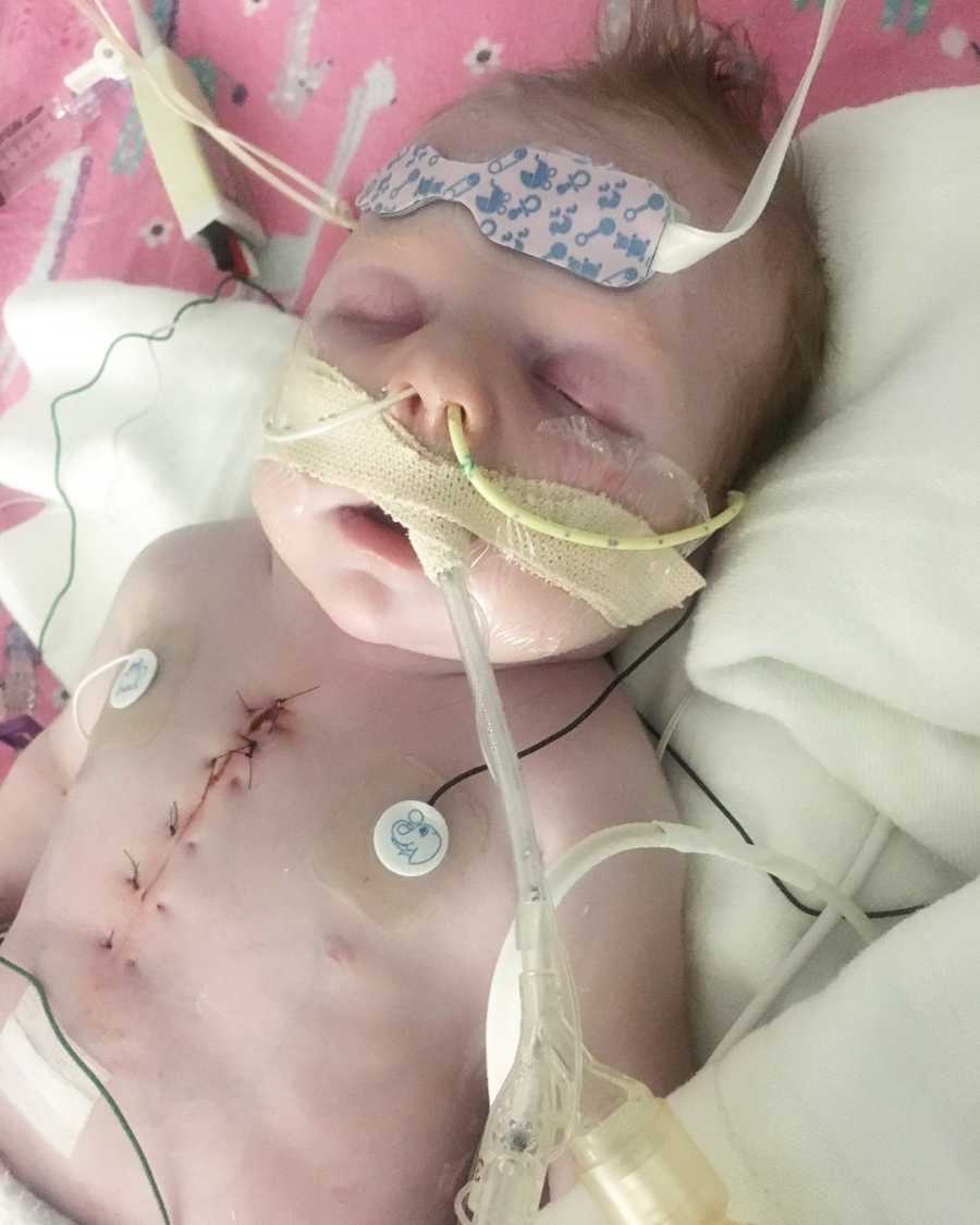 Newborn baby asleep after open heart surgery with scar down middle of her chest