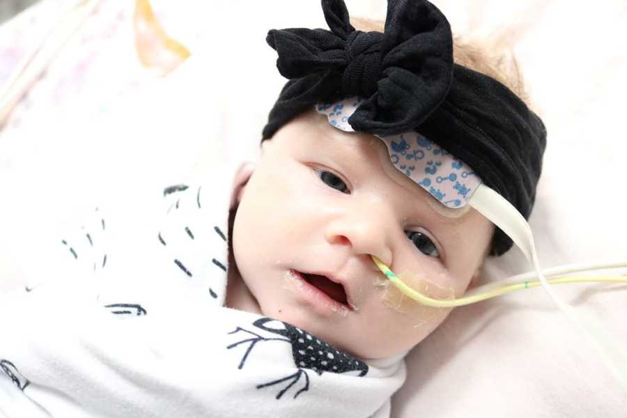 Baby girl with black on on her head lying in hospital with wire up her nose after open heart surgery