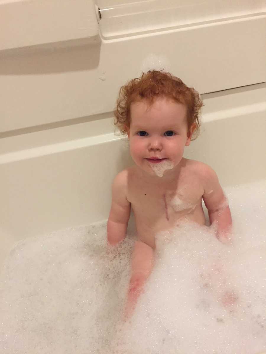 Toddler sits in bathtub with open heart surgery scar down center of chest