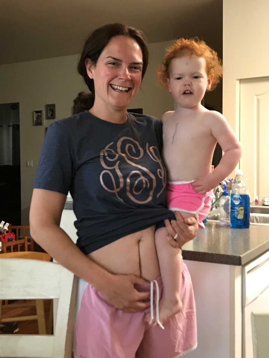 Mother holds up shirt showing appendix rupture scar while holding daughter with open heart surgery scar