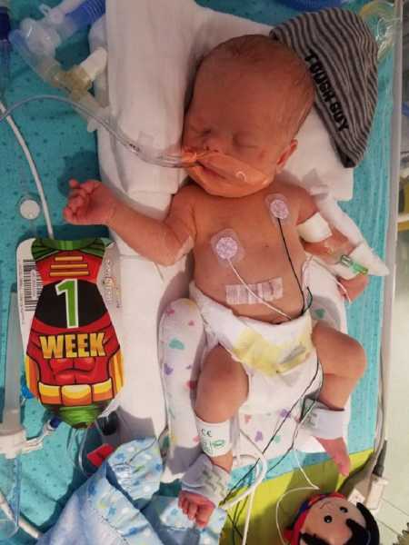 Newborn with down syndrome lying in hospital bed with wires attached to him 