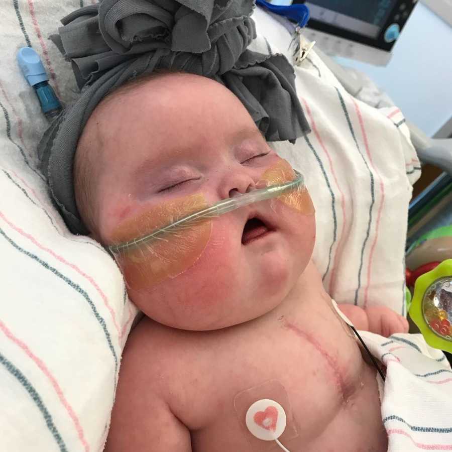 Baby girl sleeping in hospital bed after open heart surgery 