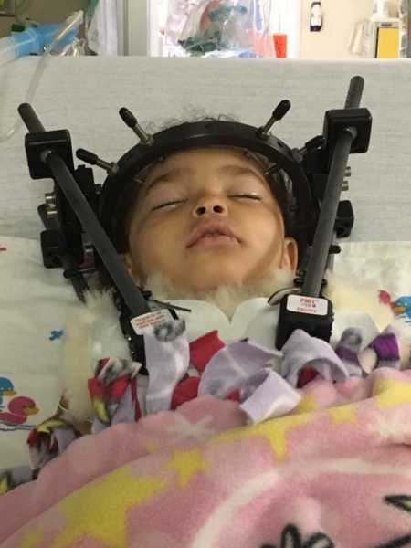 Toddler in head brace in hospital bed after being internally decepitated