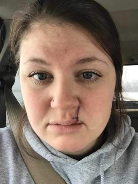 Woman after skin cancer removal with scar on her lip 