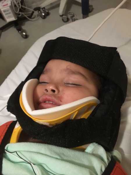 Toddler in head brace after car crash that left her internally decapitated
