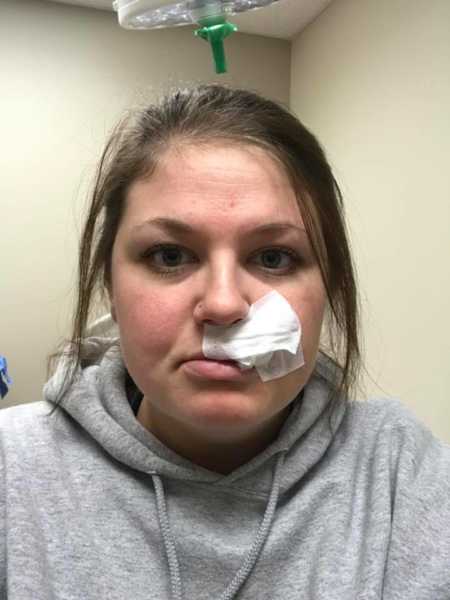 Woman with gauze on her lip after skin cancer removal