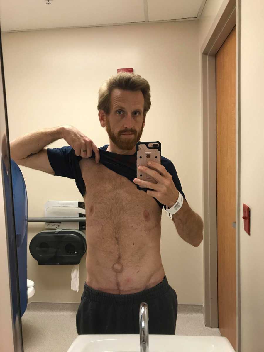 Man holds up shirt in mirror selfie after umbilical hernia revision surgery