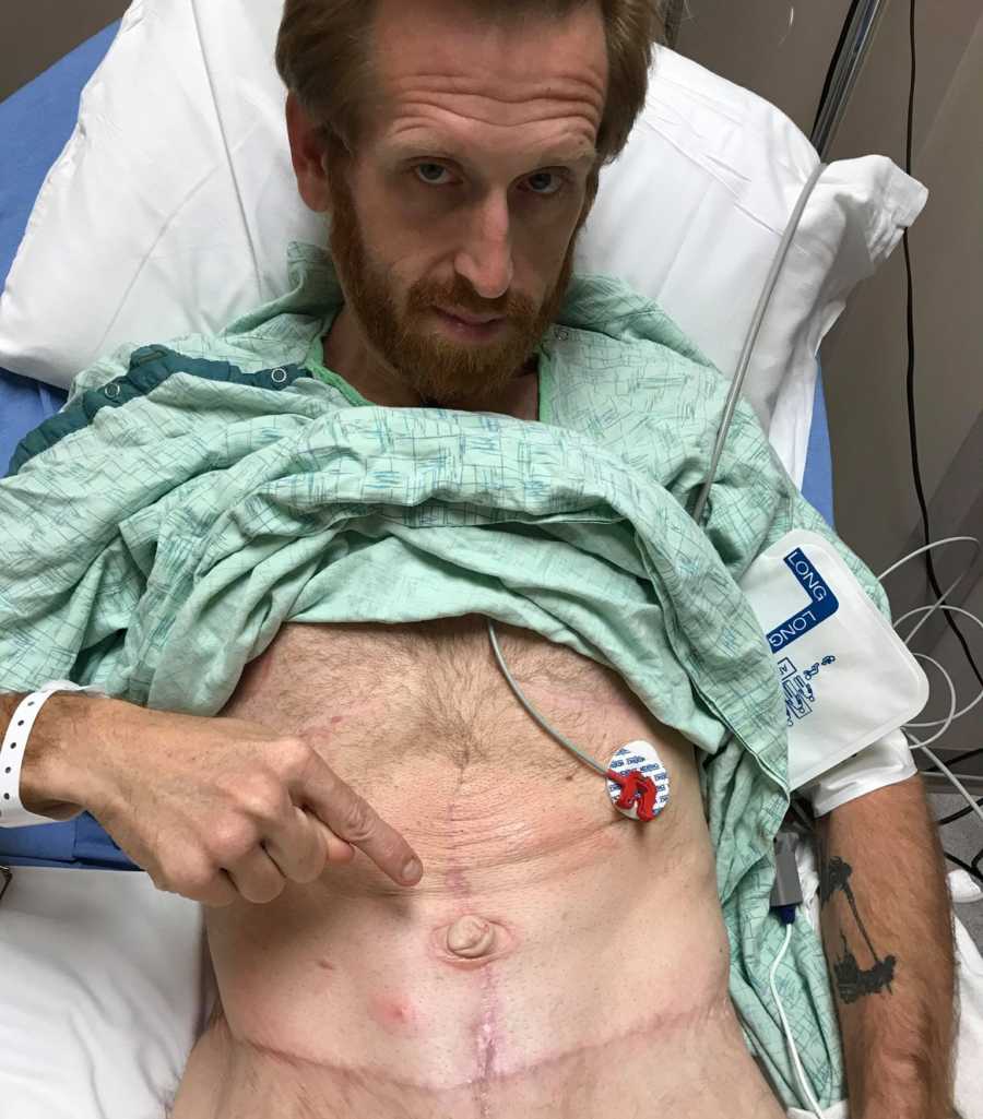 Man pointing to stomach in hospital bed after umbilical hernia revision surgery