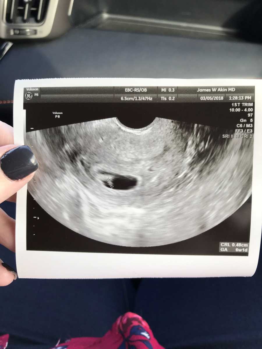 Ultrasound from woman who struggled with infertility
