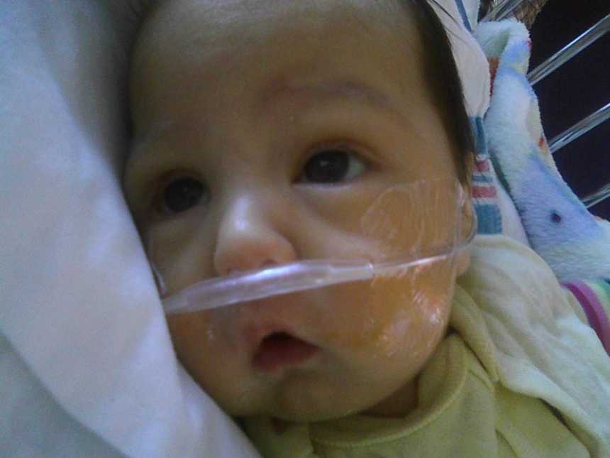Close up of baby's face who needs liver transplant with oxygen up her nose