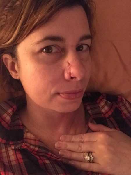 Woman with scar on her nose from skin cancer removal takes selfie