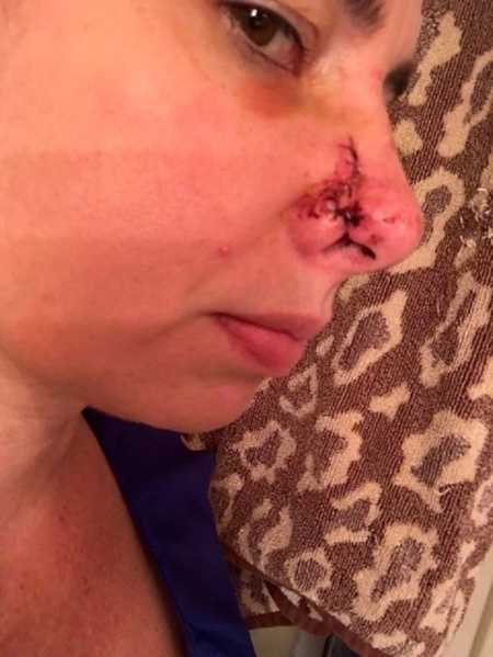 Scar on woman's nose after having skin cancer removed