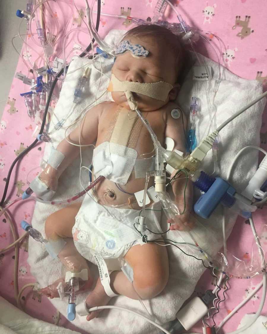 Newborn baby sleeping in hospital with wires and tubes attached to her after open heart surgery