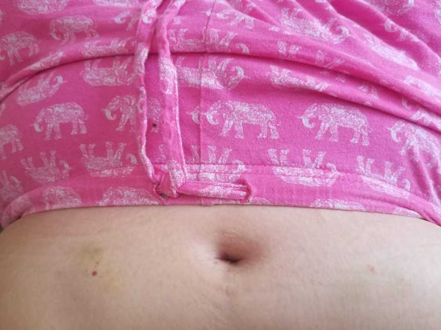 Aerial view of woman who always wanted to be a mother's stomach with bruise from injecting fertility medication