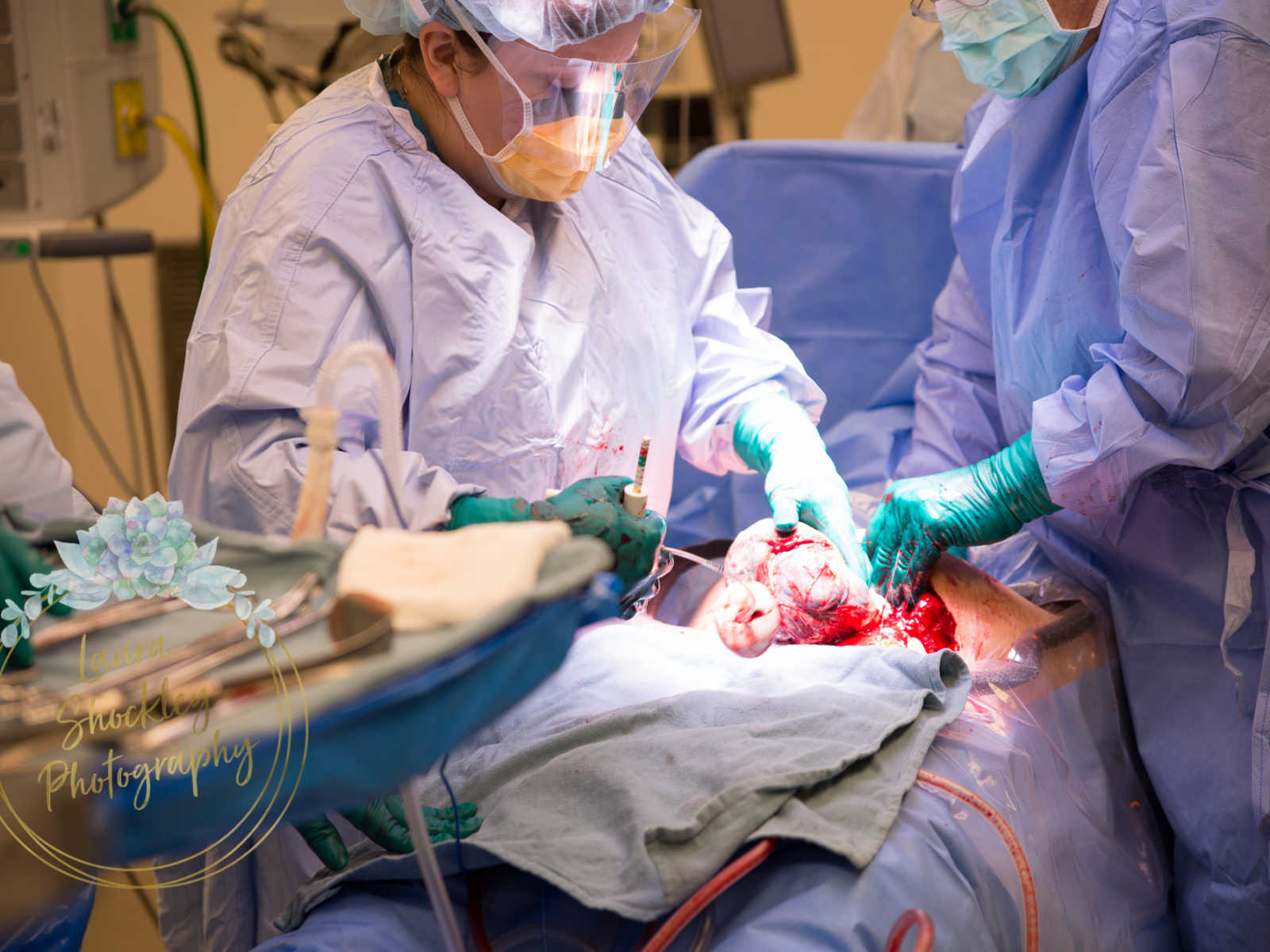 Doctors pull baby's head out during c-section