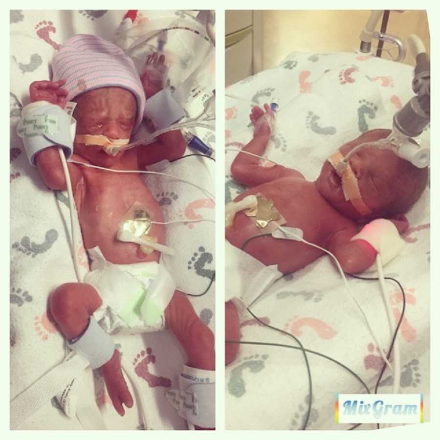 Underweight twin newborns in NICU after mother who had fertility issues gave birth