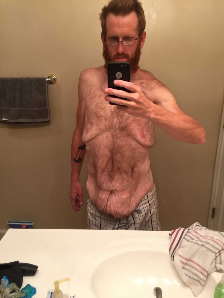 Man who had gastric bypass surgery takes mirror selfie in bathroom with saggy skin