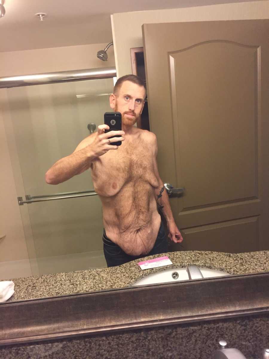 Man takes selfie in bathroom mirror with saggy skin after gastric bypass surgery